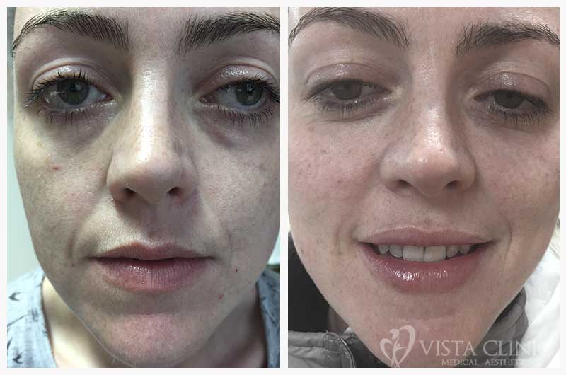Before and after cheek filler at Vista Clinic, showing improved mid-face contour