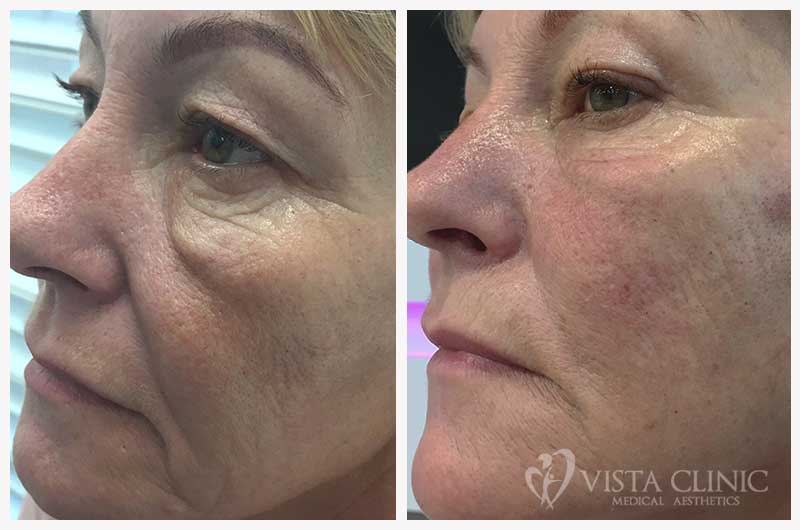 Before and after cheek filler at Vista Clinic, showing restored volume through the cheekbone