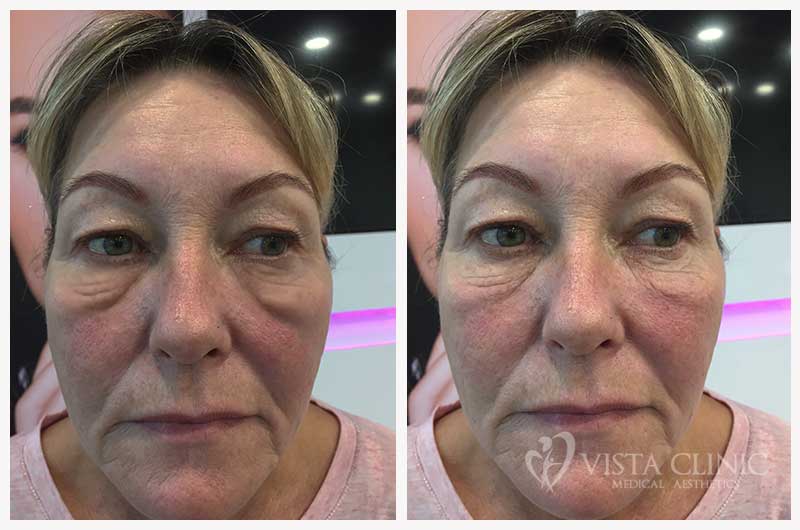 Before and after dermal filler treatment at Vista Clinic, showing restored mid-face volume