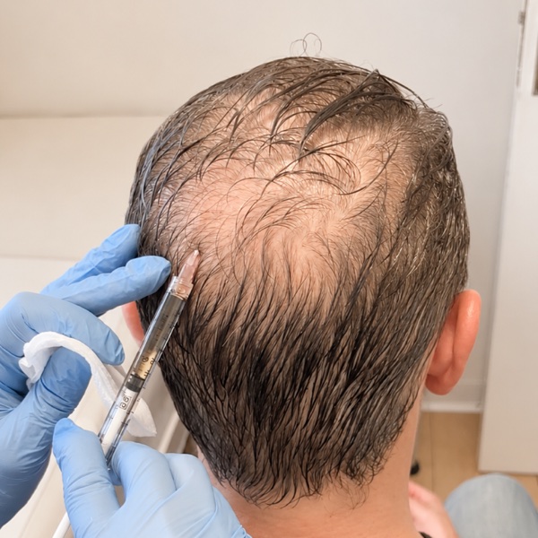 Clinician performing a PRP hair loss treatment on a patient scalp at Vista Clinic Dublin