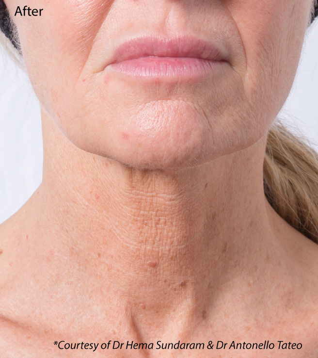 Profhilo neck bio-remodelling, after treatment