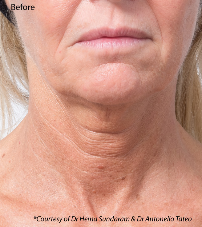 Profhilo neck bio-remodelling, before treatment